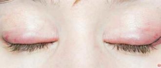 Воспаление после татуажа век