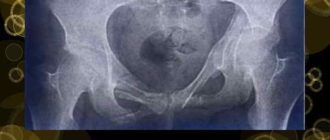 Деформация тазового кольца