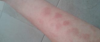 На ногах, руках и лице красные пятна