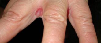 Между пальцами покраснение и шелушение