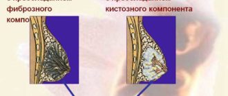 Дифузная фибромо-кистозная мастопатия