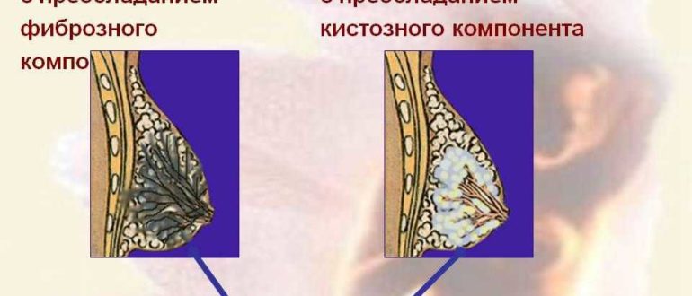 Дифузная фибромо-кистозная мастопатия