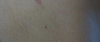 Место удаления родинки красное и уплотнение