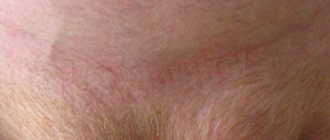 Волосики на лобке у грудничка