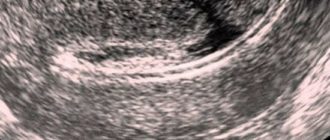 Узи после кесарево