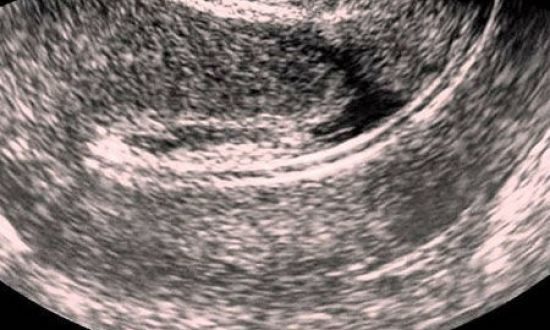 Узи после кесарево