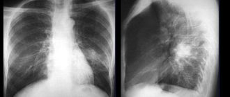 Долго рассасывается очаг пневмонии