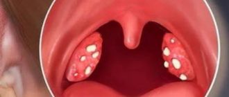 Черное образование в горле