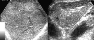 Диффузно-очаговые изменения 3 степени