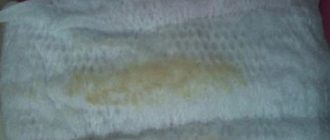 Выделения белые при джес