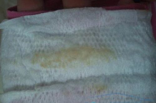 Выделения белые при джес