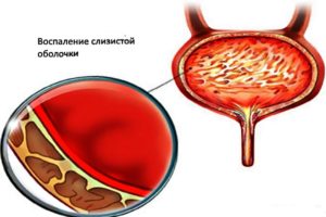 Влияние кишечной палочки на мочевой пузырь