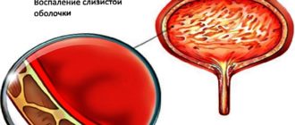 Влияние кишечной палочки на мочевой пузырь