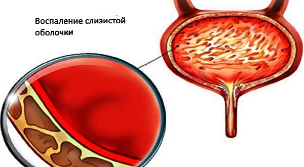 Влияние кишечной палочки на мочевой пузырь