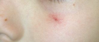 На лице появилась маленькая красная точка