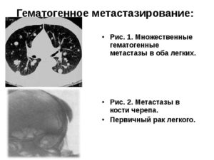 Метастазы или первичный рак?