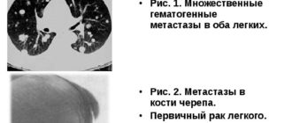 Метастазы или первичный рак?