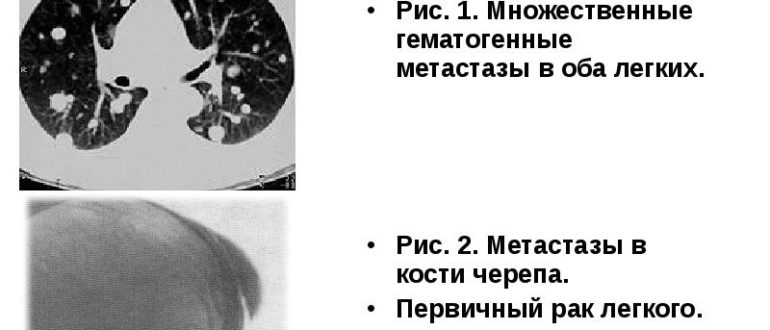 Метастазы или первичный рак?