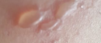 Волдыри как при ожоге, белые у ребёнка