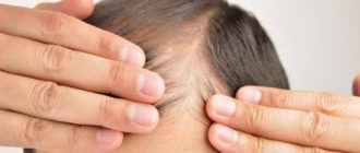 Выпадение волос на фоне использования Новаринга