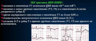 Нарушение проведения по правой ножке пучка Гиса