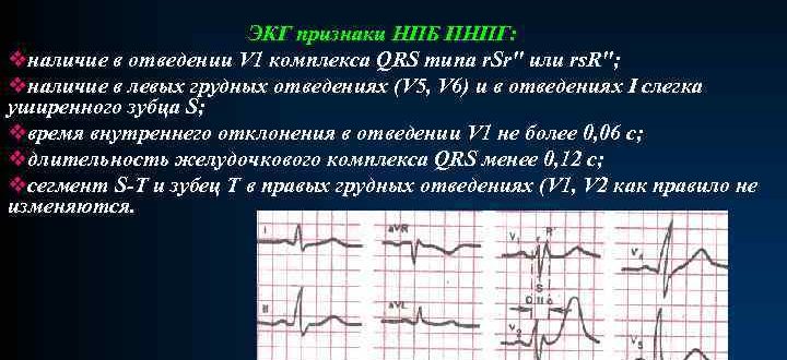 Нарушение проведения по правой ножке пучка Гиса