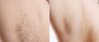 Может ли лазерная эпиляция подмышечных впадин спровацировать новообразования в груди?
