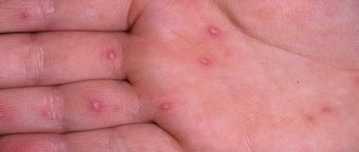 Водянистые пузырьки, не герпес