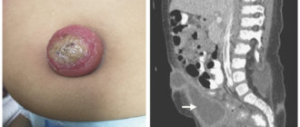 Воспаление соска после механической травмы