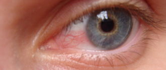 Уже три года краснеет половина глаза