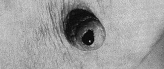 Выделение крови из соска груди при его надавливании