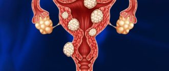 Миома матки