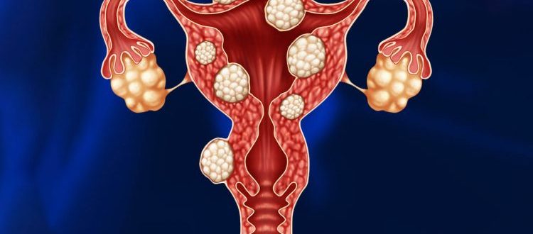 Миома матки