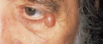 Эпидермальная киста