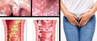 Молочница одолела