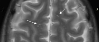 Мрт головного мозга глиоз или РС