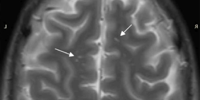 Мрт головного мозга глиоз или РС