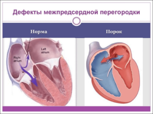 Дефект межпредсердной перегородки у новорожденного