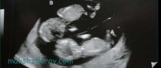 Выделения в 18 недель беременности