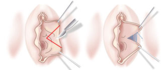 Мне 16 лет но у меня нет малых половых губ
