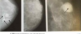 Диффузные изменения молочных желез