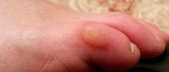 В мозоль попала грязь