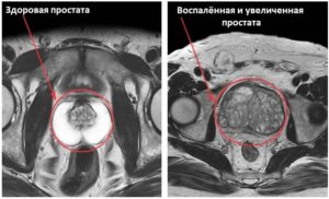 МРТ предстательной железы