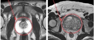 МРТ предстательной железы