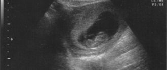 УЗИ ребёнка (2 месяца)