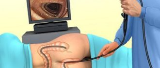 Возможна ли колоносклпия при спайках м. таза