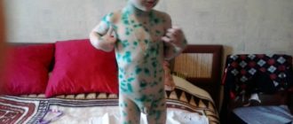 Ветрянка на половом члене у ребёнка