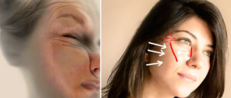 Морщины от сна, как избавиться?