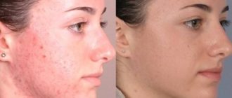 Демодекоз, роаккутан при легкой стадии угревой болезни