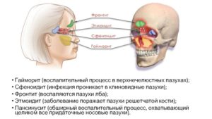 Двусторонний верхнечелюстной синусит, этмоидит, сфеноидит